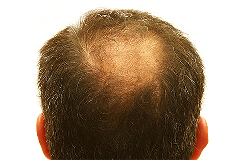 chinese regrow hair naturally